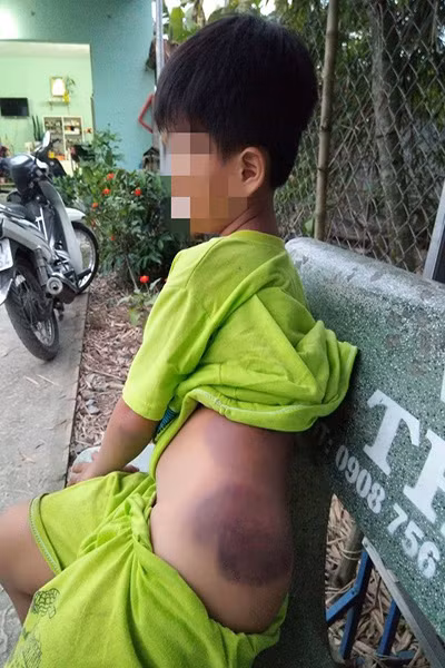 Em Khang bị bầm tím ở lưng, mông sau khi bị cô Vui đánh (ảnh: vtc.vn)
