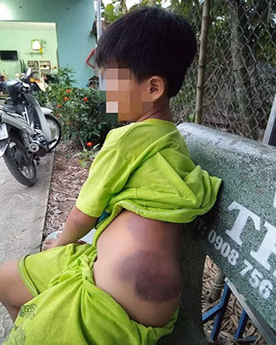 Em K.bị bầm tím ở lưng, mông sau khi bị cô Vui đánh (ảnh: vtc.vn)
