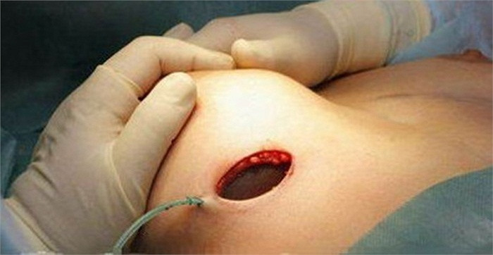 Khoét một chỗ để nhét silicon vào Khoét một chỗ để nhét silicon vào