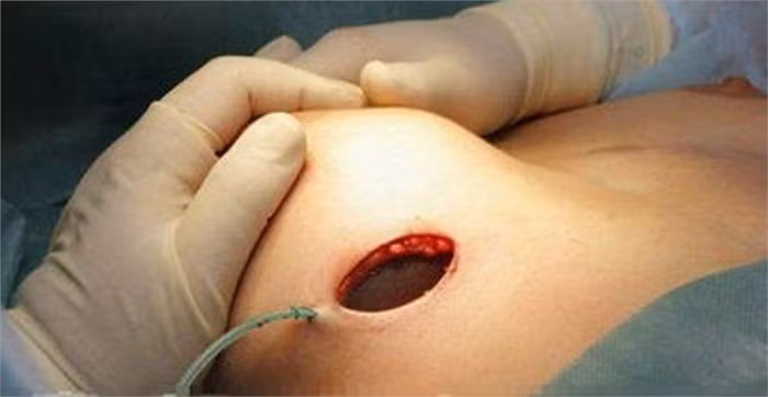 Khoét một chỗ để nhét silicon vào