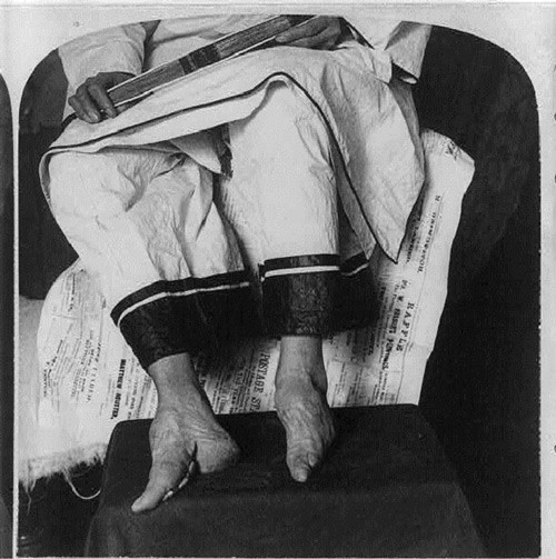 Hình ảnh đôi chân "dị dạng" thường thấy của những phụ nữ Trung Quốc thời xưa.