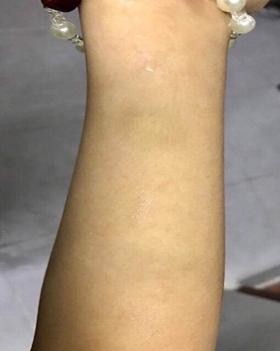 Hình ảnh chứng minh bé N.A bị cô H. đánh là có thương tích, là vết bầm tím trên tay (Ảnh: B.A) Hình ảnh chứng minh bé N.A bị cô H. đánh là có thương tích, là vết bầm tím trên tay (Ảnh: B.A)