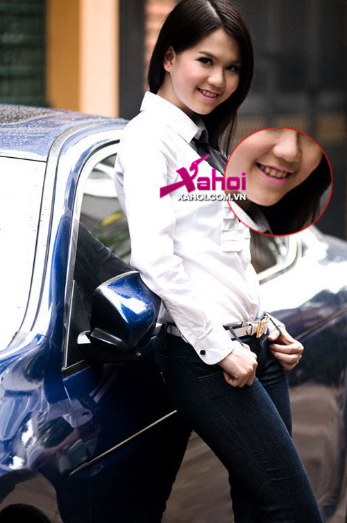 Khiếm khuyết này khiến nụ cười người đẹp kém duyên.