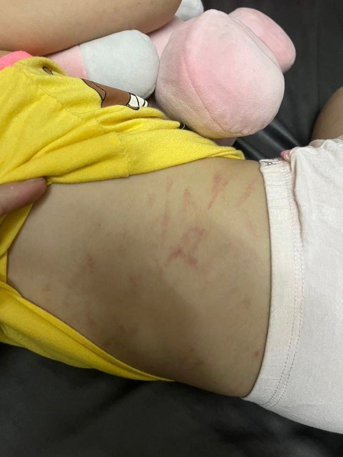 Vết đỏ sau lưng bé T. được gia đình chụp lại (Ảnh: Phụ huynh cung cấp) Vết đỏ sau lưng bé T. được gia đình chụp lại (Ảnh: Phụ huynh cung cấp)