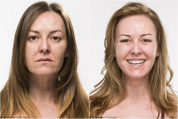 Karen trước và ngay sau đợt thẩm mỹ. Karen trước và ngay sau đợt thẩm mỹ.