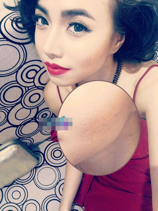 Khuôn mặt Đinh Ngọc Diệp lồi lõm do vết tích của mụn.