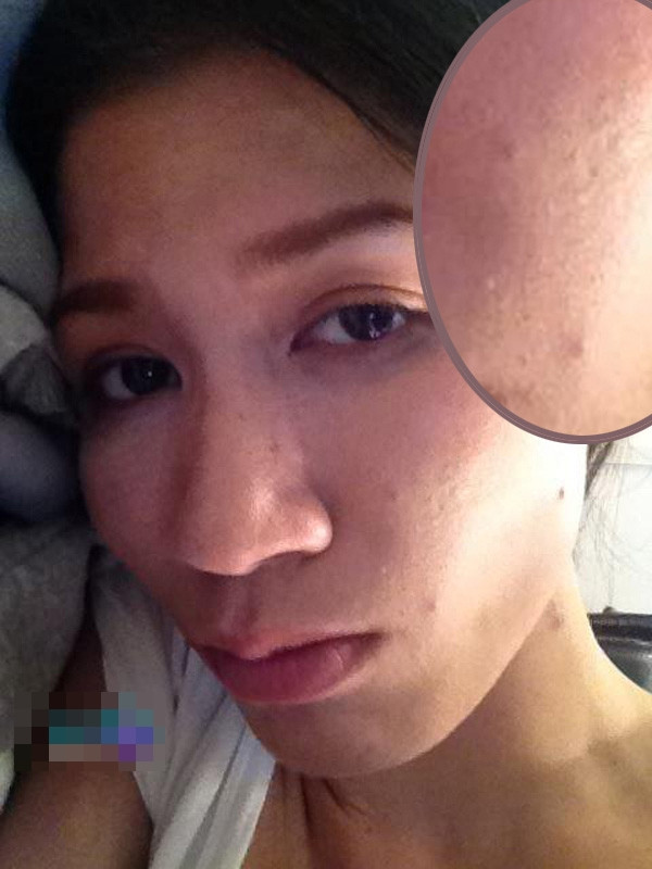 Khuôn mặt Trang Trần sần sùi vì mụn đầu đen.