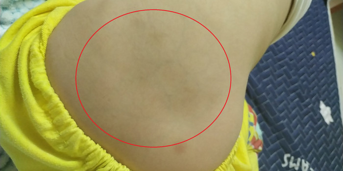 Hình ảnh phụ huynh chia sẻ lưng con được cho là bị cô giáo dùng chân đạp vào gây bầm tím. Ảnh: NVCC. Hình ảnh phụ huynh chia sẻ lưng con được cho là bị cô giáo dùng chân đạp vào gây bầm tím. Ảnh: NVCC.