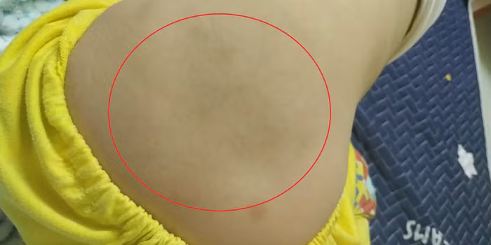 Hình ảnh phụ huynh chia sẻ lưng con được cho là bị cô giáo dùng chân đạp vào gây bầm tím. Ảnh: NVCC.