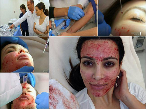 Kim bị gọi là "ma cà rồng" sau khi làm đẹp bằng phương pháp này.