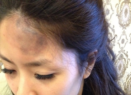 Chị Tạ Hoàng Tâm và vết thương từ lần bị đánh “hội đồng”. Chị Tạ Hoàng Tâm và vết thương từ lần bị đánh “hội đồng”.