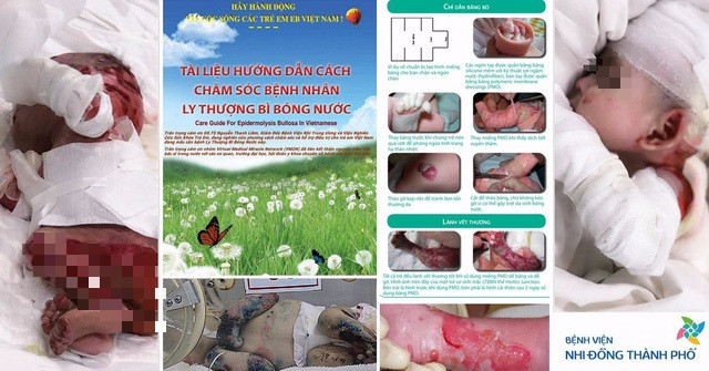 Tài liệu hướng dẫn chăm sóc bệnh nhân ly thượng bì bóng nước của Bệnh viện Nhi đồng Thành phố Hồ Chí Minh Tài liệu hướng dẫn chăm sóc bệnh nhân ly thượng bì bóng nước của Bệnh viện Nhi đồng Thành phố Hồ Chí Minh