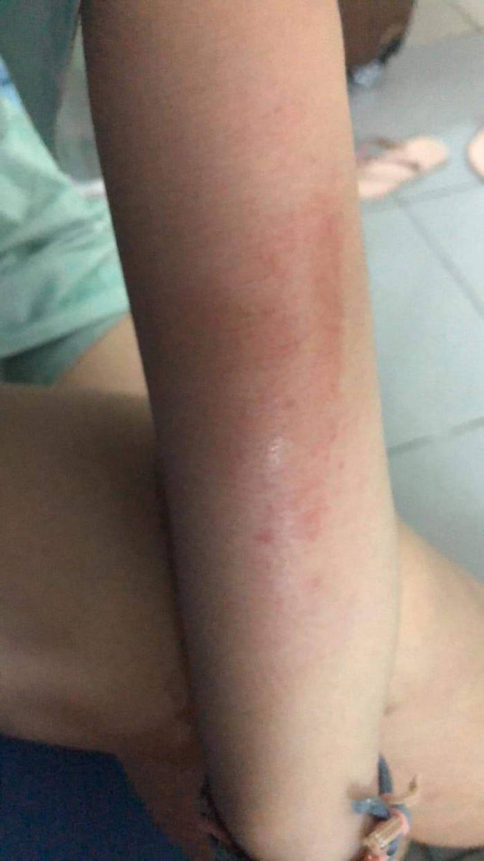 Trên người em T. vẫn còn dấu vết trầy xước do bị bạn đánh (ảnh: CTV) Trên người em T. vẫn còn dấu vết trầy xước do bị bạn đánh (ảnh: CTV)