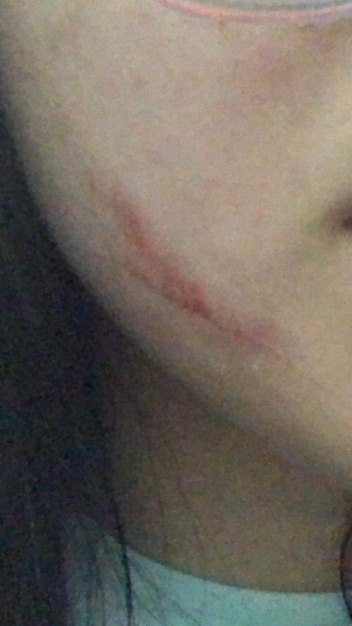 Vết thương còn hiện rõ trên mặt em T. sau khi bị bạn tát (ảnh: CTV) Vết thương còn hiện rõ trên mặt em T. sau khi bị bạn tát (ảnh: CTV)