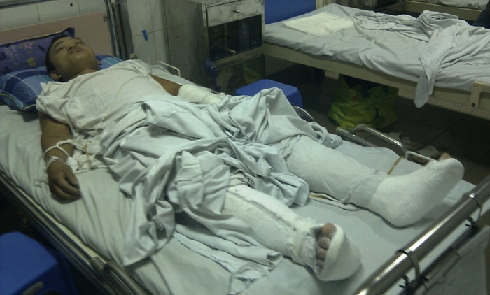 Nạn nhân Vũ Hữu Huấn tại bệnh viện Việt Đức - Hà Nội