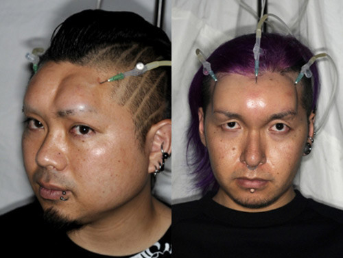 Trán phồng Nhật Bản được thực hiện ở cả nam và nữ.