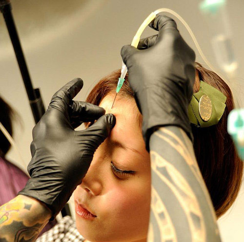 Một cô gái tên Asami bắt đầu được cắm kim vào trán để truyền saline.