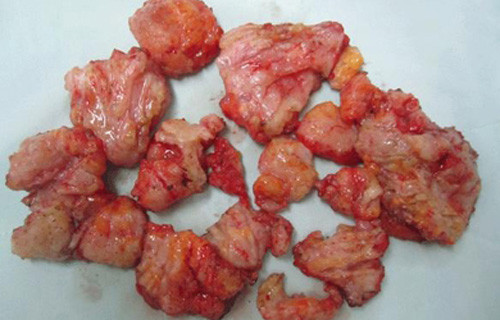 Lượng silicon đã ngấm vào các mô mỡ và mạch máu gây ra tắc phổi kèm suy hô hấp nặng Lượng silicon đã ngấm vào các mô mỡ và mạch máu gây ra tắc phổi kèm suy hô hấp nặng