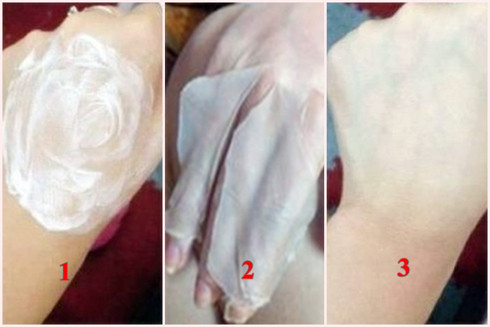 Tay chị Linh biến đổi hoàn toàn sau khi dùng kem tẩy trắng da. Tay chị Linh biến đổi hoàn toàn sau khi dùng kem tẩy trắng da.