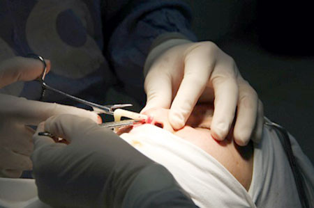 Cận cảnh một ca phẫu thuật nâng mũi.