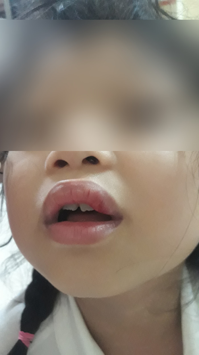 Hình ảnh môi cháu bé bị sưng, phụ huynh nghi do cô giáo chủ nhiệm. Ảnh: PHCC. Hình ảnh môi cháu bé bị sưng, phụ huynh nghi do cô giáo chủ nhiệm. Ảnh: PHCC.