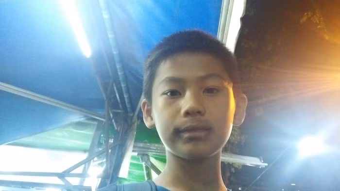 Miệng Thuận bị phỏng rộp do thổi dầu, xăng, nhìn rất rõ (Ảnh: Vũ Ninh)