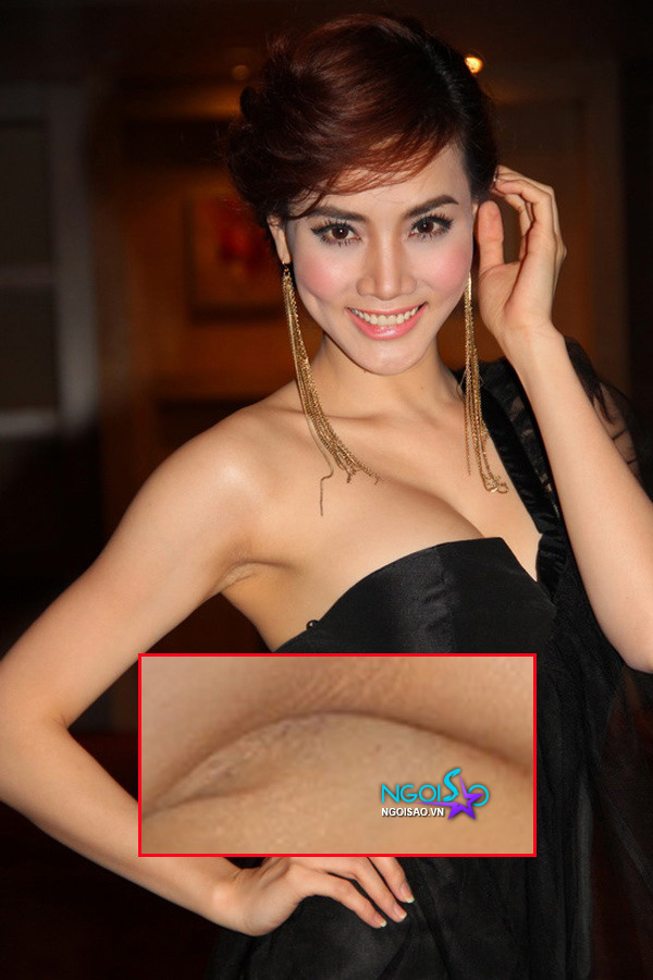 Vùng nách của Trang Nhung tối màu và bị sần.