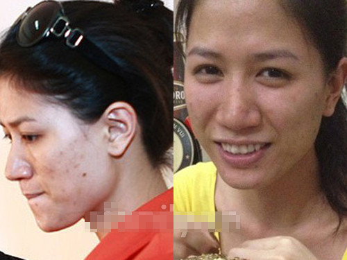 Trang Trần xấu xí khi mụn mọc khắp mặt.