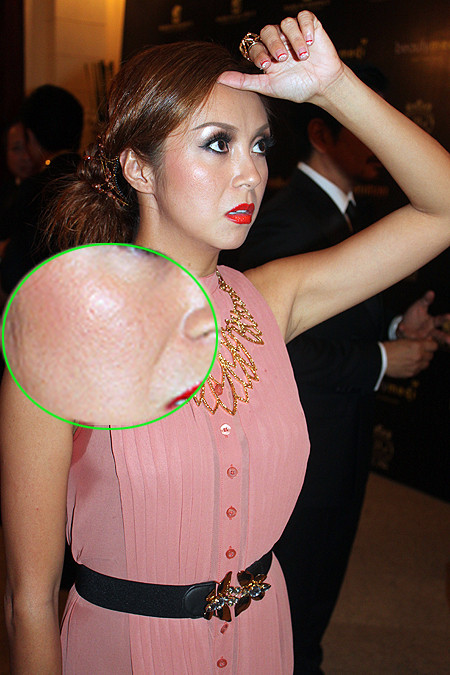 Nguyệt Anh và khuôn mặt thô, xấu xí vì lỗ chân lông quá to.