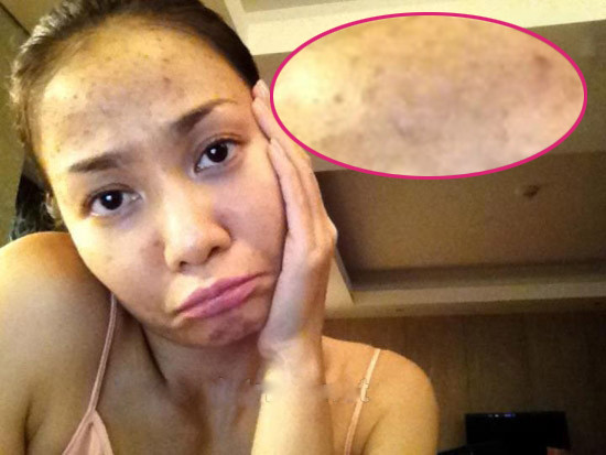 Không chỉ 'lộ' mụn sần sùi, cô nàng còn 'khoe' làn da thâm vì sẹo mụn.