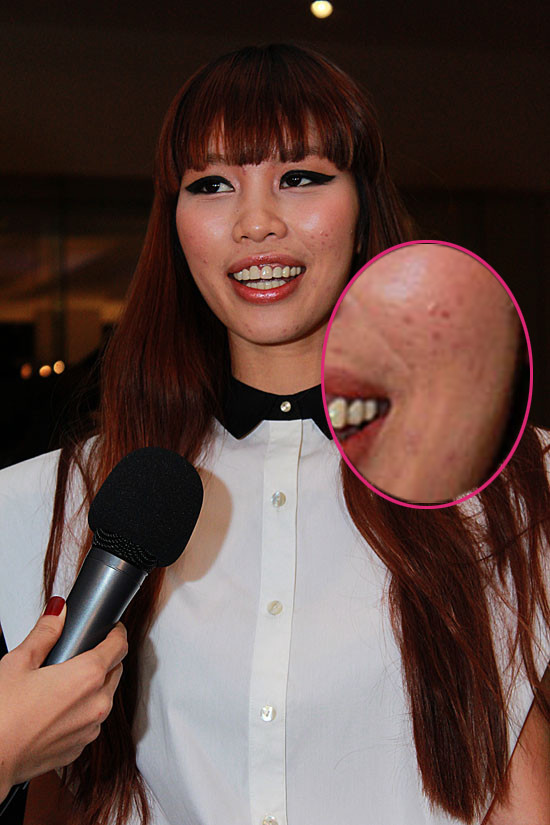 Khá nhiều lần siêu mẫu Hà Anh để lộ làn da mụn xấu xí, khó coi của mình.