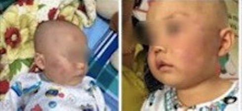 Hình ảnh bé H. bị sưng má vì bị bảo mẫu tát (ảnh: CTV)