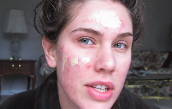 Bằng cách dùng nhiều lớp che khuyết điểm, kem nền có độ che phủ cao, Cassy đã giấu đi được những khuyết điểm đáng buồn của mình.