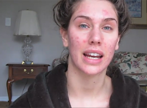 Da của Cassy bị dị ứng nổi mụn to, mụn nhỏ sần sùi chi chít.