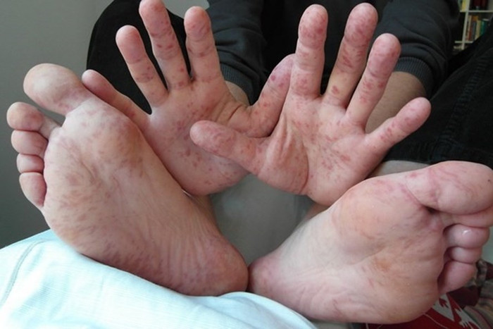 Các bác sĩ khuyến cáo, hiện chưa có thuốc đặc trị bệnh tay chân miệng, bởi vậy để phòng tránh cha mẹ tăng cường vệ sinh, đặc biệt là rửa tay thường xuyên, dùng dụng cụ, bát đĩa riêng, huấn luyện cho các bé không mút tay, ngậm đồ chơi và vệ sinh đúng chỗ. Các bác sĩ khuyến cáo, hiện chưa có thuốc đặc trị bệnh tay chân miệng, bởi vậy để phòng tránh cha mẹ tăng cường vệ sinh, đặc biệt là rửa tay thường xuyên, dùng dụng cụ, bát đĩa riêng, huấn luyện cho các bé không mút tay, ngậm đồ chơi và vệ sinh đúng chỗ.