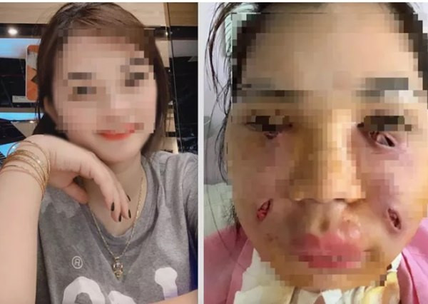 Hình ảnh cô Nguyễn Thị H. trước và sau khi bị nhiễm trùng khi thực hiện "tiêm mỡ tự thân". (Ảnh: Giadinhvietnam.com) Hình ảnh cô Nguyễn Thị H. trước và sau khi bị nhiễm trùng khi thực hiện "tiêm mỡ tự thân". (Ảnh: Giadinhvietnam.com)