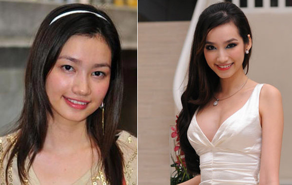 Hoa hậu Trúc Diễm cũng chi tiền cho chiếc cằm được như ý.