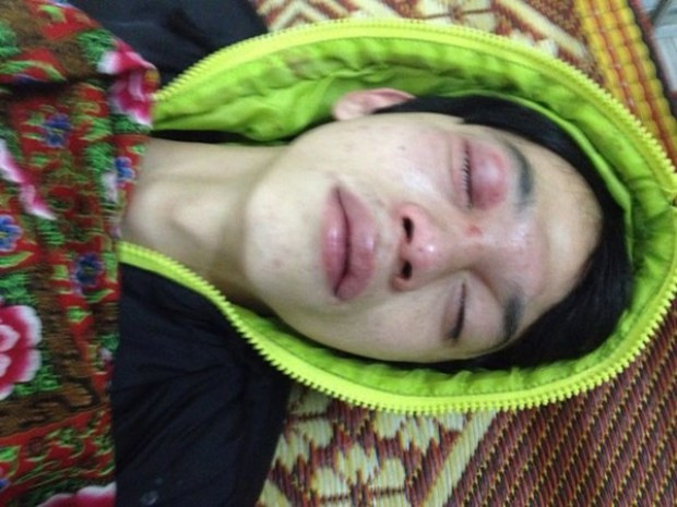 Anh Đông với thương tích trên mặt. Anh Đông với thương tích trên mặt.