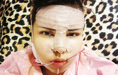 Gương mặt Peggy ngay sau khi phẫu thuật. Ảnh: Yahoo!Singapore