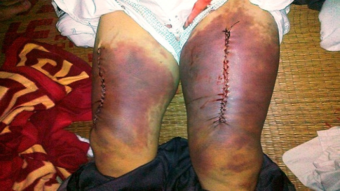 Vết thương ở đùi ông Thuận do 4 công an xã Kim Nỗ gây nên