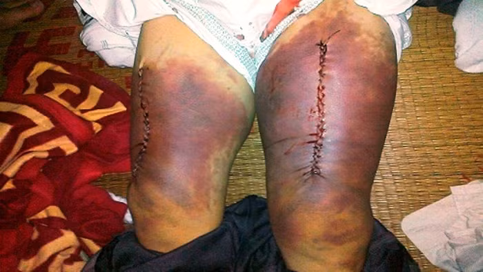 Vết thương ở đùi ông Thuận do 4 công an xã Kim Nỗ gây nên