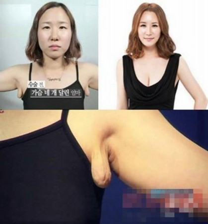 Trước đây, Song Ah Young thường xuyên mặc cảm vì hai khổi thịt bất thường mọc ra ở nách. Sau khi sinh con, quá lo lắng vì phần ngực có dấu hiệu nhỏ lại, trong khi hai khối thịt lại không ngừng to ra, Kim đã mắc bệnh trầm cảm, không dám tiếp xúc với những người xung quanh. Được sự trợ giúp của các bác sĩ thẩm mỹ, hiện Kim Ah Yong đã sở hữu vòng một căng đầy và dung nhan quyến rũ. Trước đây, Song Ah Young thường xuyên mặc cảm vì hai khổi thịt bất thường mọc ra ở nách. Sau khi sinh con, quá lo lắng vì phần ngực có dấu hiệu nhỏ lại, trong khi hai khối thịt lại không ngừng to ra, Kim đã mắc bệnh trầm cảm, không dám tiếp xúc với những người xung quanh. Được sự trợ giúp của các bác sĩ thẩm mỹ, hiện Kim Ah Yong đã sở hữu vòng một căng đầy và dung nhan quyến rũ.