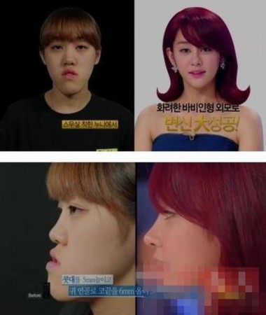 Heo Ji Hoon luôn xấu hổ vì khuôn mặt bị gãy của mình. Dưới bàn tay của các bác sĩ thẩm mỹ, chiếc cằm vô duyên trước kia của cô đã trở nên thon gọn, mũi cũng được nâng cao hơn. Hiện tại, Heo Ji Hoon đã có diện mạo chẳng thua kém gì một ngôi sao Hàn Quốc. Heo Ji Hoon luôn xấu hổ vì khuôn mặt bị gãy của mình. Dưới bàn tay của các bác sĩ thẩm mỹ, chiếc cằm vô duyên trước kia của cô đã trở nên thon gọn, mũi cũng được nâng cao hơn. Hiện tại, Heo Ji Hoon đã có diện mạo chẳng thua kém gì một ngôi sao Hàn Quốc.