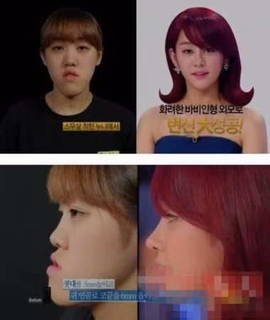 Heo Ji Hoon luôn xấu hổ vì khuôn mặt bị gãy của mình. Dưới bàn tay của các bác sĩ thẩm mỹ, chiếc cằm vô duyên trước kia của cô đã trở nên thon gọn, mũi cũng được nâng cao hơn. Hiện tại, Heo Ji Hoon đã có diện mạo chẳng thua kém gì một ngôi sao Hàn Quốc.