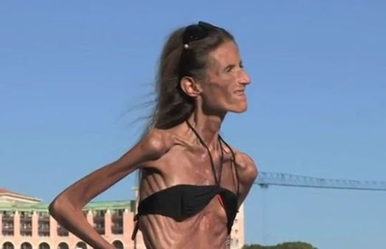 Cô chỉ mong ước được trở lại cuộc sống như bao người bình thường khác, được ăn uống bình thường, được hẹn hò, không bị xa lánh, bị yêu thương, thậm chí được xây dựng một gia đình hạnh phúc sinh con đẻ cái. Cô chỉ mong ước được trở lại cuộc sống như bao người bình thường khác, được ăn uống bình thường, được hẹn hò, không bị xa lánh, bị yêu thương, thậm chí được xây dựng một gia đình hạnh phúc sinh con đẻ cái.