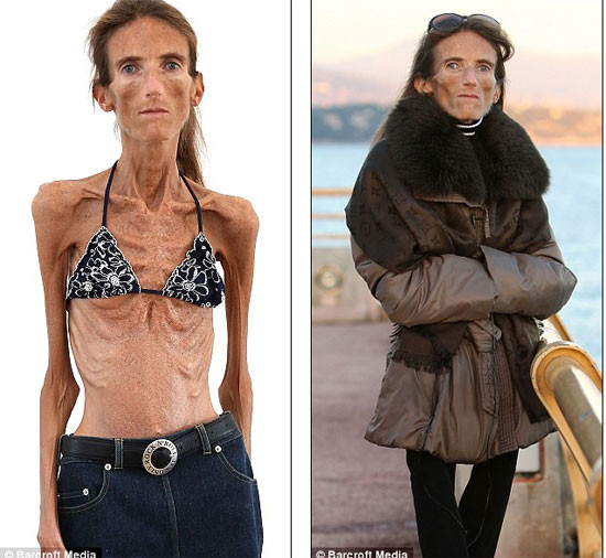 Mặc dù phải nhờ đến bác sĩ điều trị căn bệnh biếng ăn nhưng Valeria Levitin không thể chống lại căn bệnh này. Cô cũng từng tâm sự vì sự nông nổi ăn kiêng và chứng biếng ăn đã huỷ hoại cuộc sống của cô. Mặc dù phải nhờ đến bác sĩ điều trị căn bệnh biếng ăn nhưng Valeria Levitin không thể chống lại căn bệnh này. Cô cũng từng tâm sự vì sự nông nổi ăn kiêng và chứng biếng ăn đã huỷ hoại cuộc sống của cô.