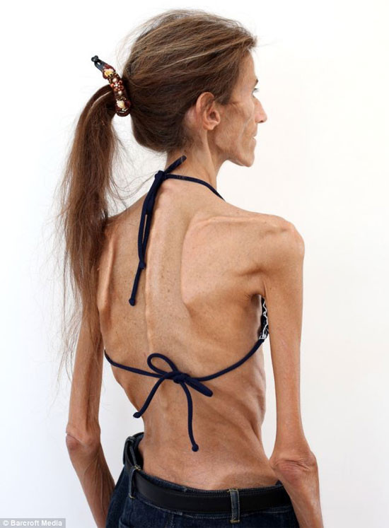 Cô muốn phát động một chiến dịch chống lại chứng biếng ăn Cô muốn phát động một chiến dịch chống lại chứng biếng ăn