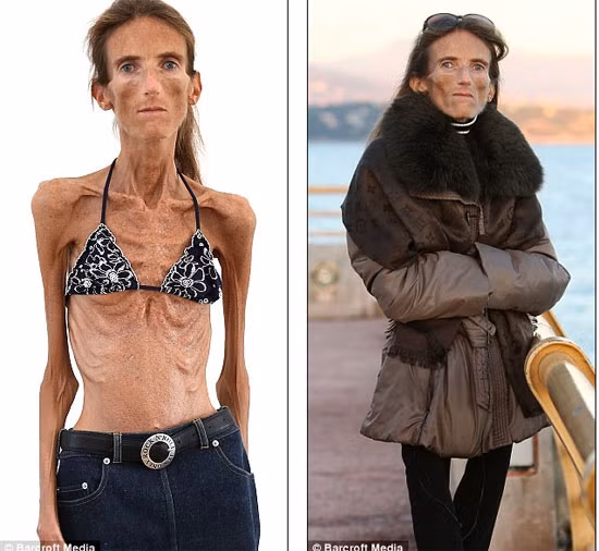 Mặc dù phải nhờ đến bác sĩ điều trị căn bệnh biếng ăn nhưng Valeria Levitin không thể chống lại căn bệnh này. Cô cũng từng tâm sự vì sự nông nổi ăn kiêng và chứng biếng ăn đã huỷ hoại cuộc sống của cô.