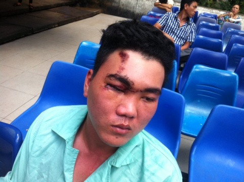 Nạn nhân Lê Thanh Hải có thể bị mù hẳn mắt phải sau vụ tai nạn này (Ảnh: H.L)