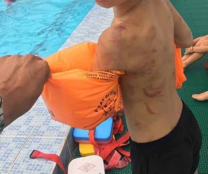 Những vết thương chi chít sau lưng của em Th. do bị ba đánh (Ảnh: CTV) Những vết thương chi chít sau lưng của em Th. do bị ba đánh (Ảnh: CTV)